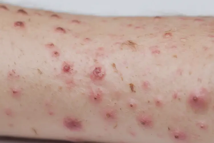 青少年全身容易長(zhǎng)濕疹能徹底自愈嗎(圖4)