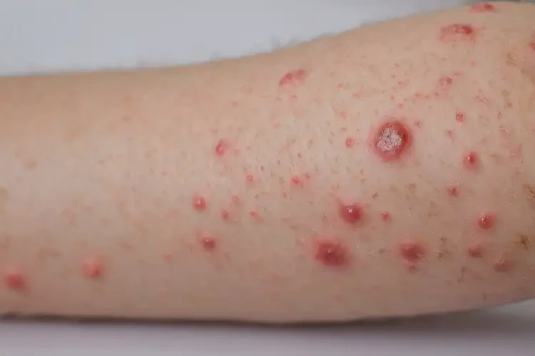 小孩全身經(jīng)常起濕疹能徹底自愈嗎(圖4)