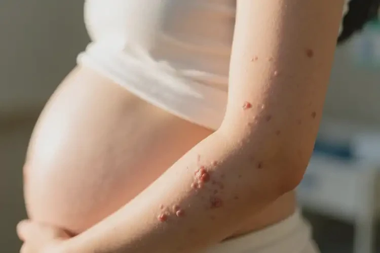 孕妇手臂容易长湿疹不管它会自己痊愈吗(图4)