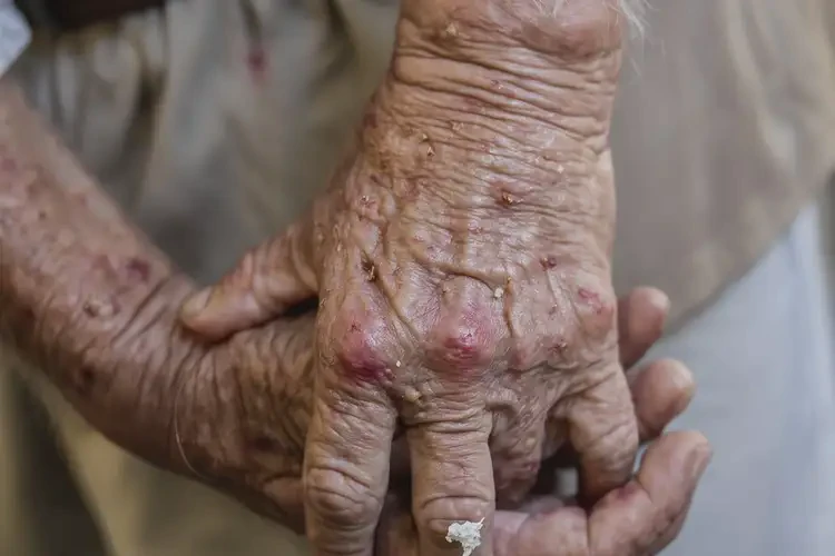 高龄老人四肢出湿疹可不可以彻底自愈(图4)
