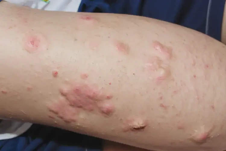 中學(xué)生大腿上有濕疹不管它會自己痊愈嗎(圖4)