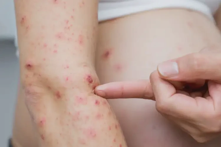 孕婦手臂長濕疹能靠自己自愈嗎(圖4)