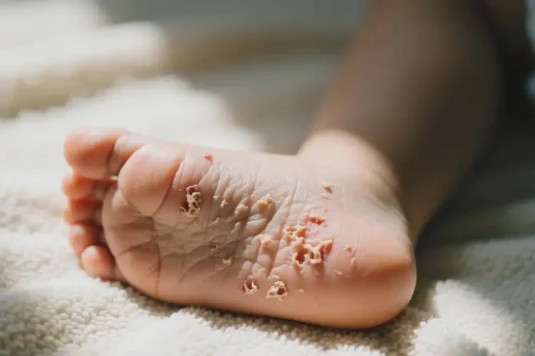 小兒腳上起濕疹不管它會自己痊愈嗎(圖2)