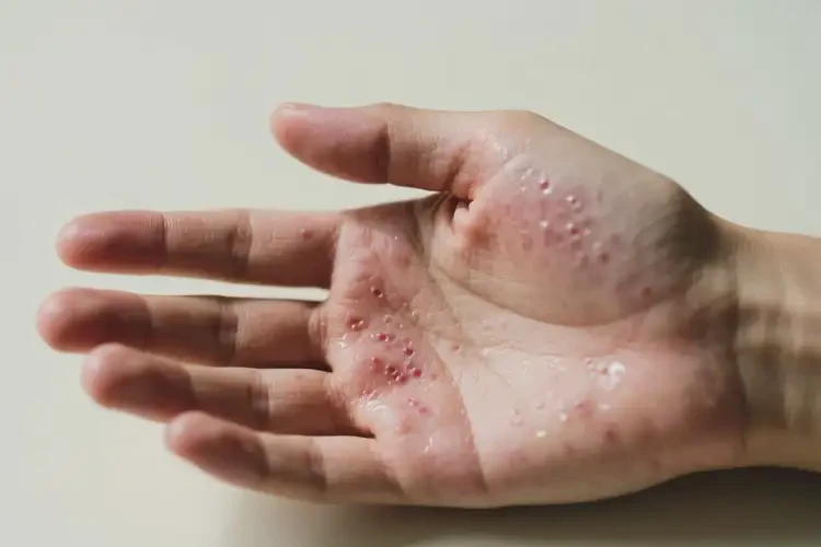 青年人手上出現(xiàn)濕疹能徹底自愈嗎(圖4)