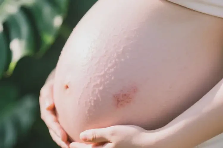 孕婦肚子上偶爾起濕疹可以徹底自愈嗎(圖2)