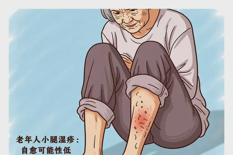老年人小腿上出現(xiàn)濕疹不管它會(huì)自己好嗎(圖4)