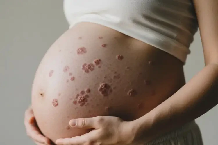 孕妇肚子上起湿疹不管它会自己好吗(图2)