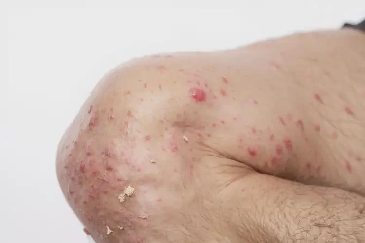 男性小腿上出現(xiàn)濕疹不管它會自己自愈嗎(圖1)