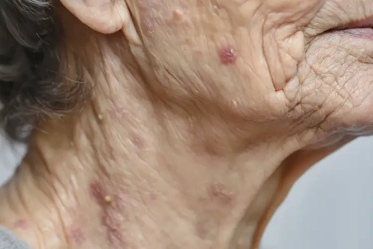 高齡老人脖子上出現(xiàn)濕疹不管它會自己好嗎(圖4)