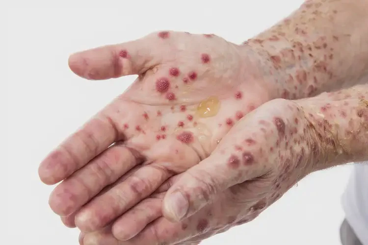 青年人手上容易起濕疹不管它會(huì)自己好嗎(圖3)