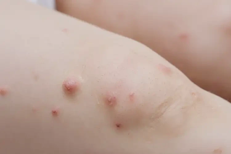 婴幼儿大腿上起湿疹可以彻底自愈吗(图4)