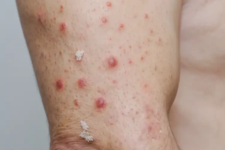 男性手臂偶爾起濕疹可以徹底自愈嗎(圖3)