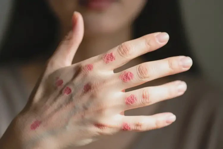 女人手上容易起湿疹不管它会自己好吗(图1)