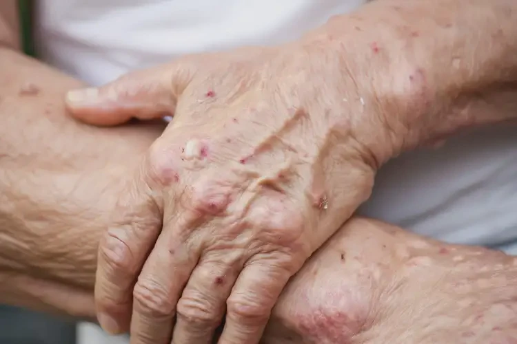 高齡老人手臂上容易長濕疹不管它會自己自愈嗎(圖4)