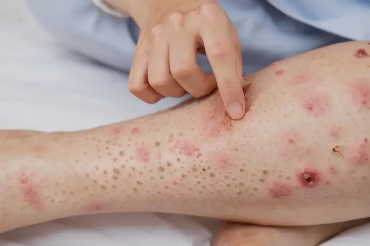 產(chǎn)婦四肢長(zhǎng)濕疹可不可以徹底自愈(圖4)