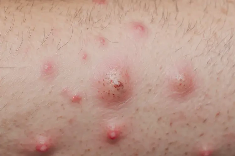 男性屁股上容易起濕疹可不可以徹底自愈(圖4)