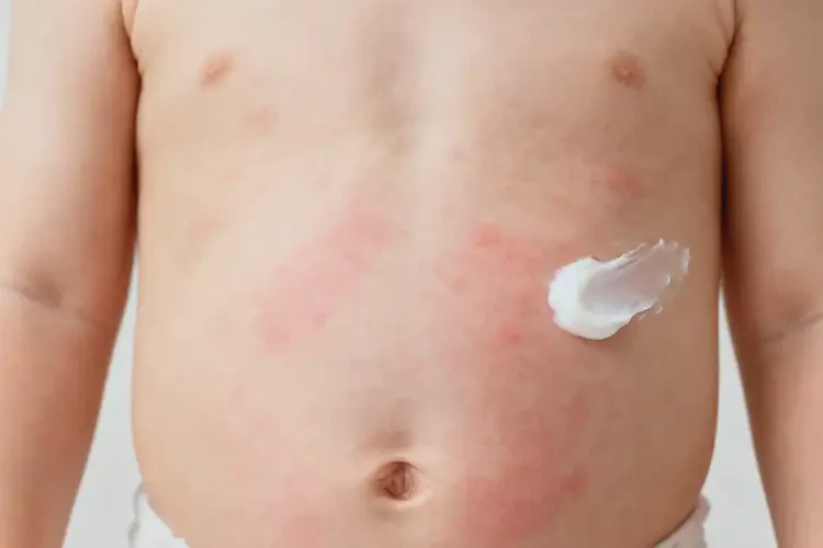 孩子肚子上偶爾起濕疹能徹底自愈嗎(圖1)