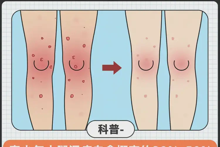 青少年大腿出濕疹不管它會自己自愈嗎(圖4)