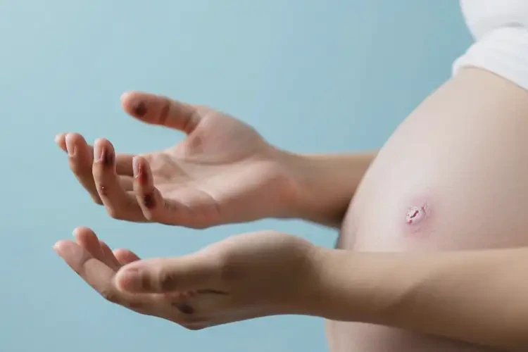 孕婦手上出濕疹不管它會自己自愈嗎(圖1)