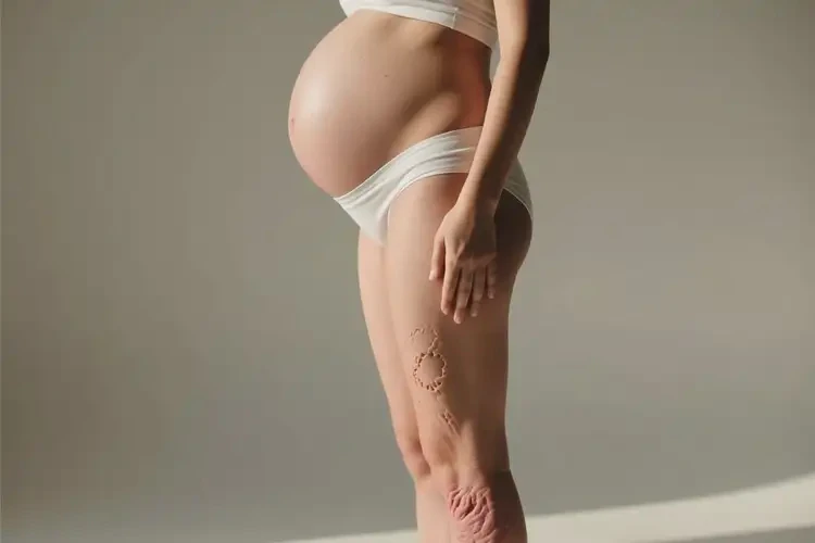 產(chǎn)婦小腿上容易起濕疹不管它會(huì)自己好嗎(圖1)