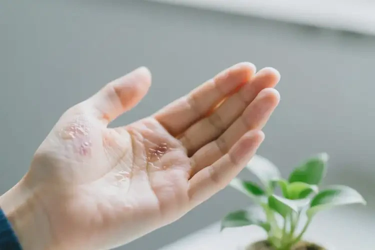 大學(xué)生手上容易長(zhǎng)濕疹可以徹底自愈嗎(圖3)