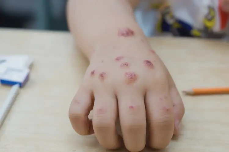 小學生手上容易起濕疹能不能徹底自愈(圖4)