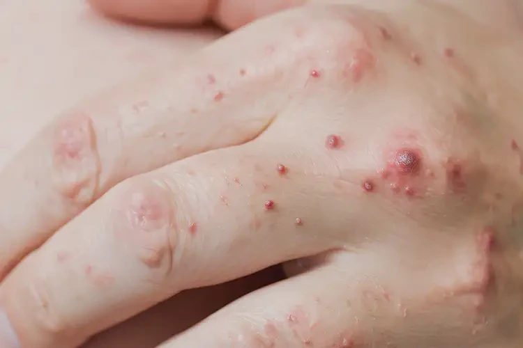 產(chǎn)婦手上起濕疹能靠自己自愈嗎(圖4)