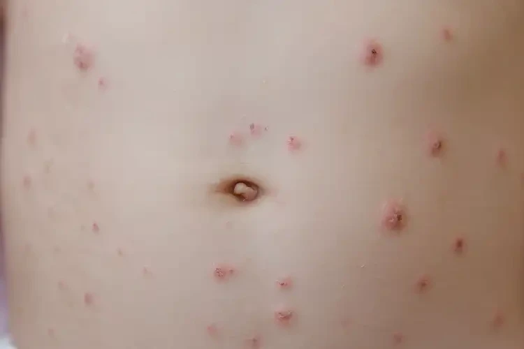 幼兒肚子上容易長濕疹可不可以徹底自愈(圖4)