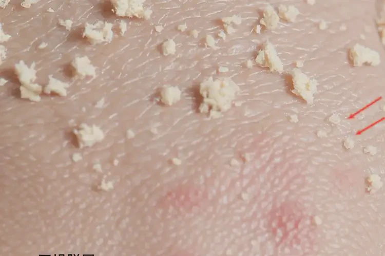 男生臉上偶爾起濕疹不管它會自己痊愈嗎(圖3)