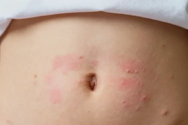中學(xué)生肚子上出現(xiàn)濕疹可以徹底自愈嗎(圖2)