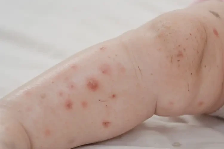 嬰兒小腿上長(zhǎng)濕疹能夠徹底治愈嗎(圖4)