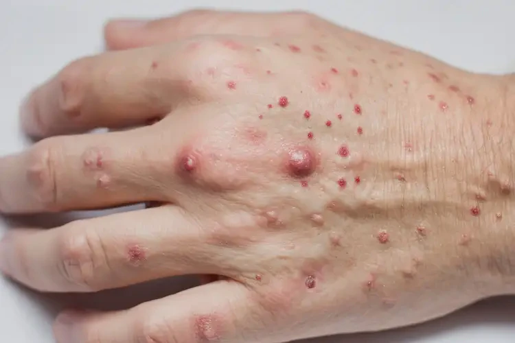 女性手上經(jīng)常起濕疹不管它會(huì)自己自愈嗎(圖4)