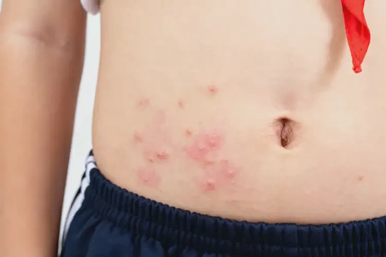 中學(xué)生肚子上出現(xiàn)濕疹可以徹底自愈嗎(圖1)
