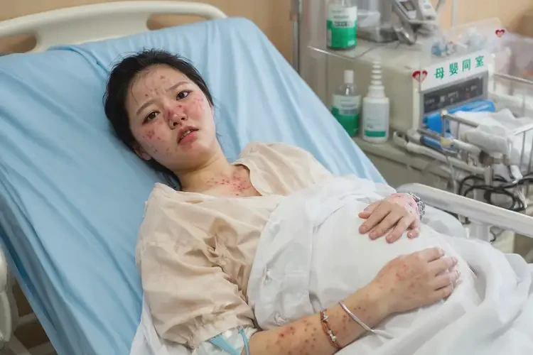 产妇屁股上经常起湿疹不管它会自己痊愈吗(图3)