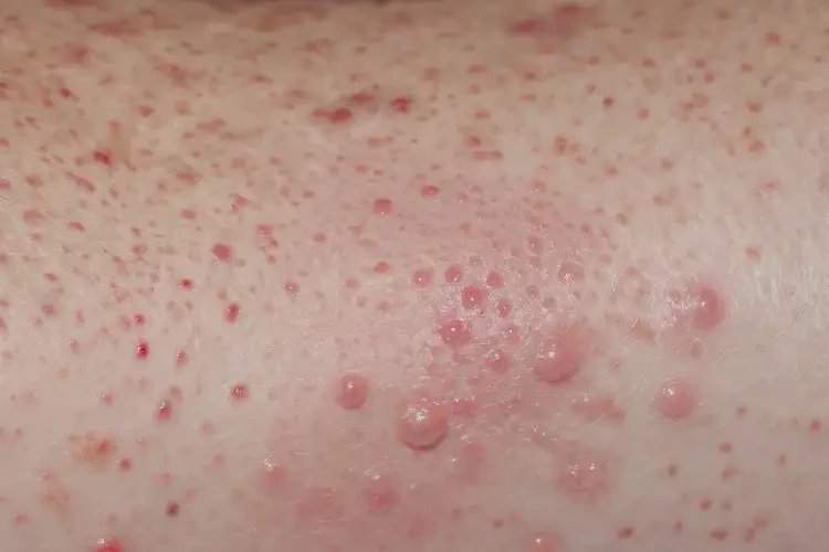 男生肚子長濕疹不管它會自己自愈嗎(圖4)