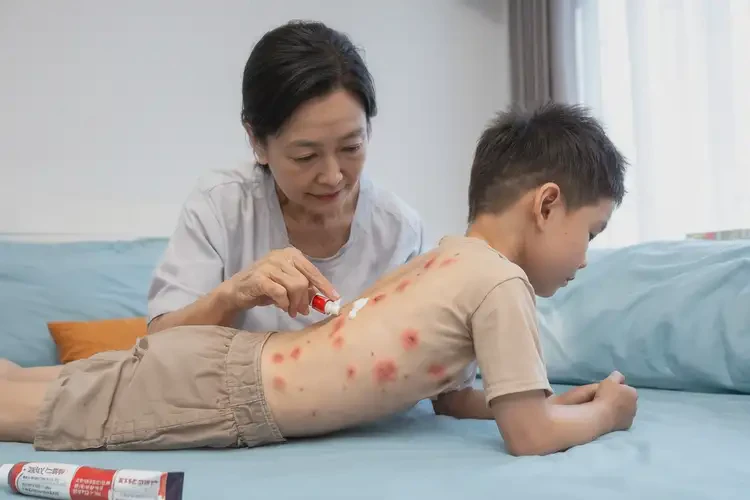 孩子肚子經(jīng)常起濕疹能徹底自愈嗎(圖3)