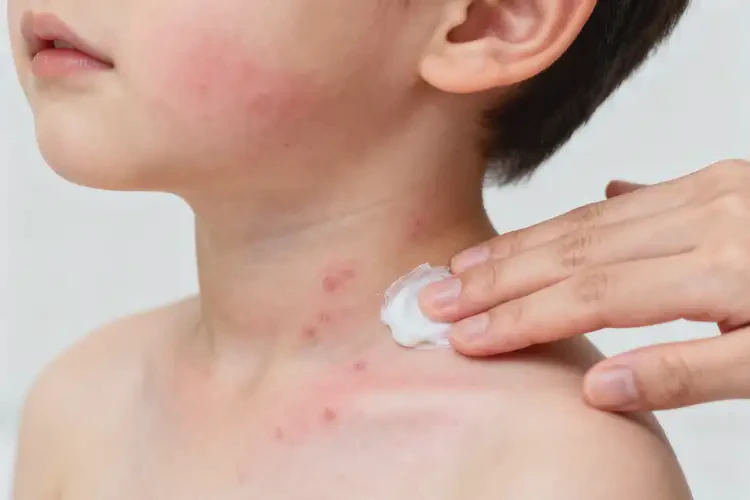 兒童脖子上出現(xiàn)濕疹可以徹底自愈嗎(圖4)