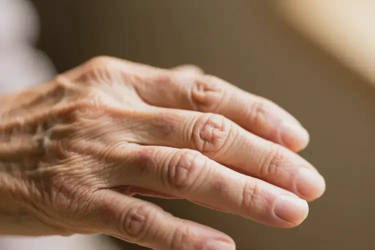 老人手臂長濕疹不管它會自己好嗎(圖3)