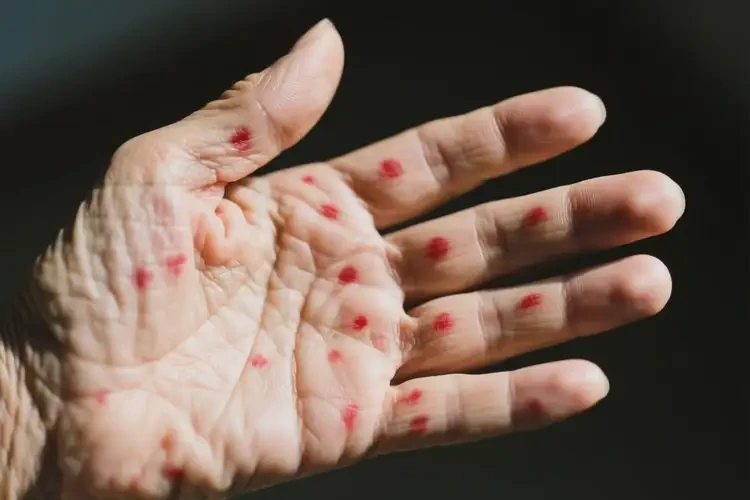 老年人手上有濕疹不管它會(huì)自己痊愈嗎(圖2)