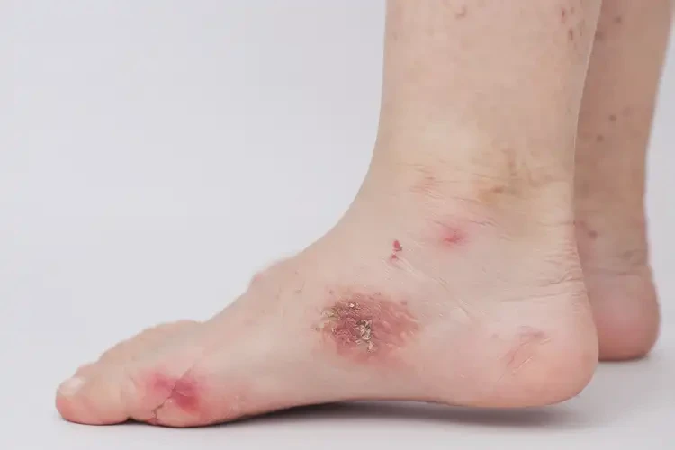 少兒腳上出現(xiàn)濕疹可不可以徹底自愈(圖4)