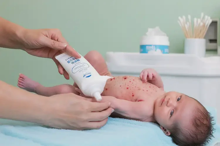寶寶大腿上容易長濕疹能夠徹底治愈嗎(圖3)