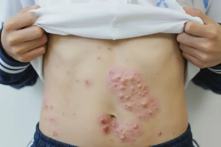 中學(xué)生肚子上容易長濕疹不管它會自己自愈嗎(圖4)