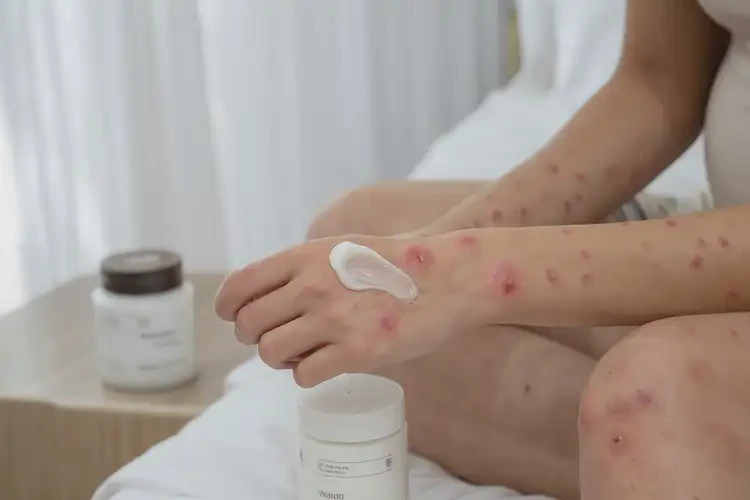 產(chǎn)婦手上起濕疹能靠自己自愈嗎(圖3)