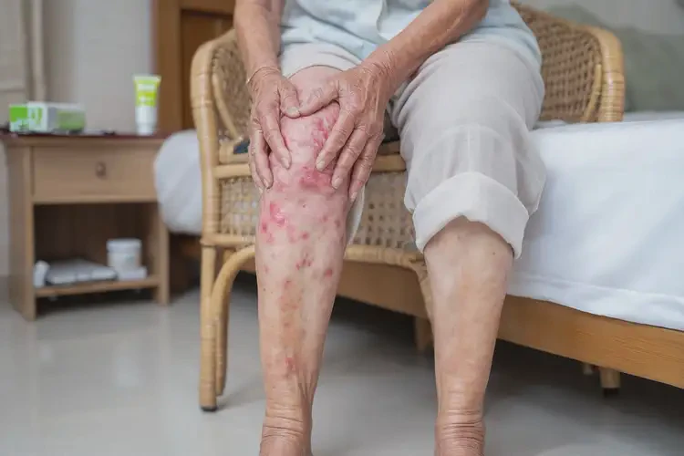 老年人大腿容易长湿疹能彻底自愈吗(图4)