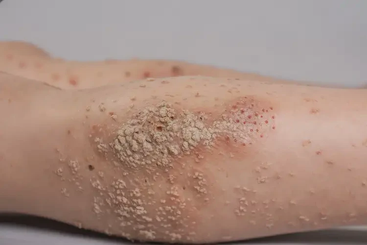 少兒小腿起濕疹能靠自己自愈嗎(圖2)