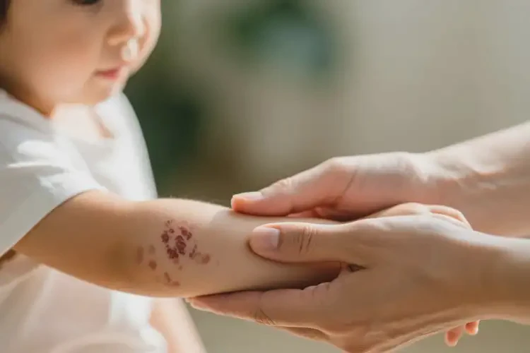 少兒手臂上有濕疹能徹底自愈嗎(圖2)