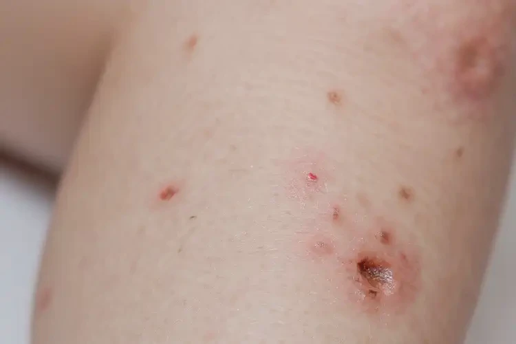 少儿小腿经常长湿疹不管它会自己自愈吗(图4)