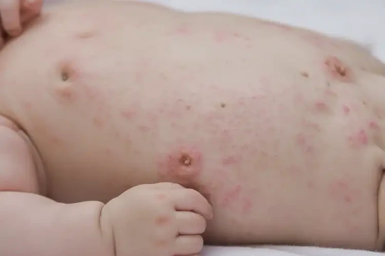 幼兒肚子上容易長(zhǎng)濕疹能夠徹底治愈嗎(圖4)