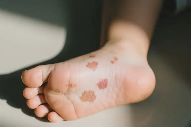 小兒腳上長濕疹不管它會(huì)自己好嗎(圖2)