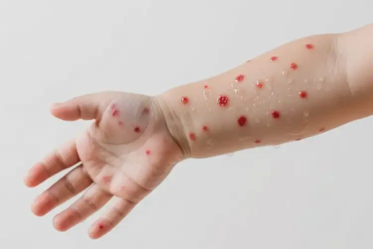 幼兒手臂上長濕疹能靠自己自愈嗎(圖1)